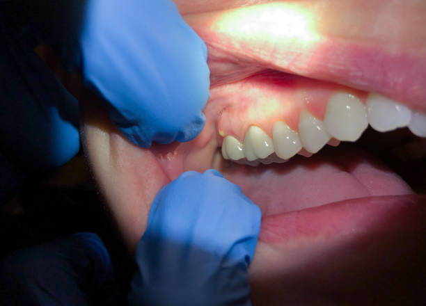 Best Broken or Chipped Tooth Repair in Gridley, CA